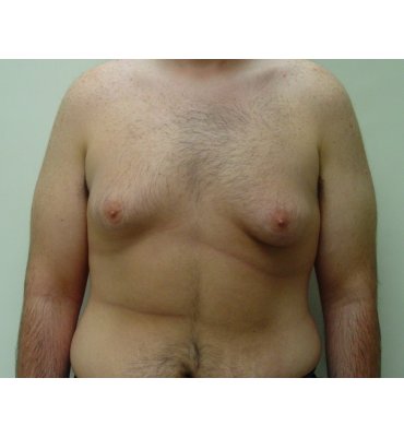 gynecomastio before